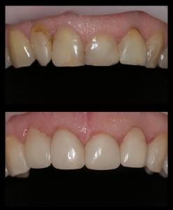 Estetinis plombavimas 1