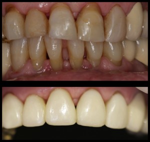 Estetinis plombavimas 3