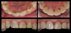 Estetinis plombavimas 6